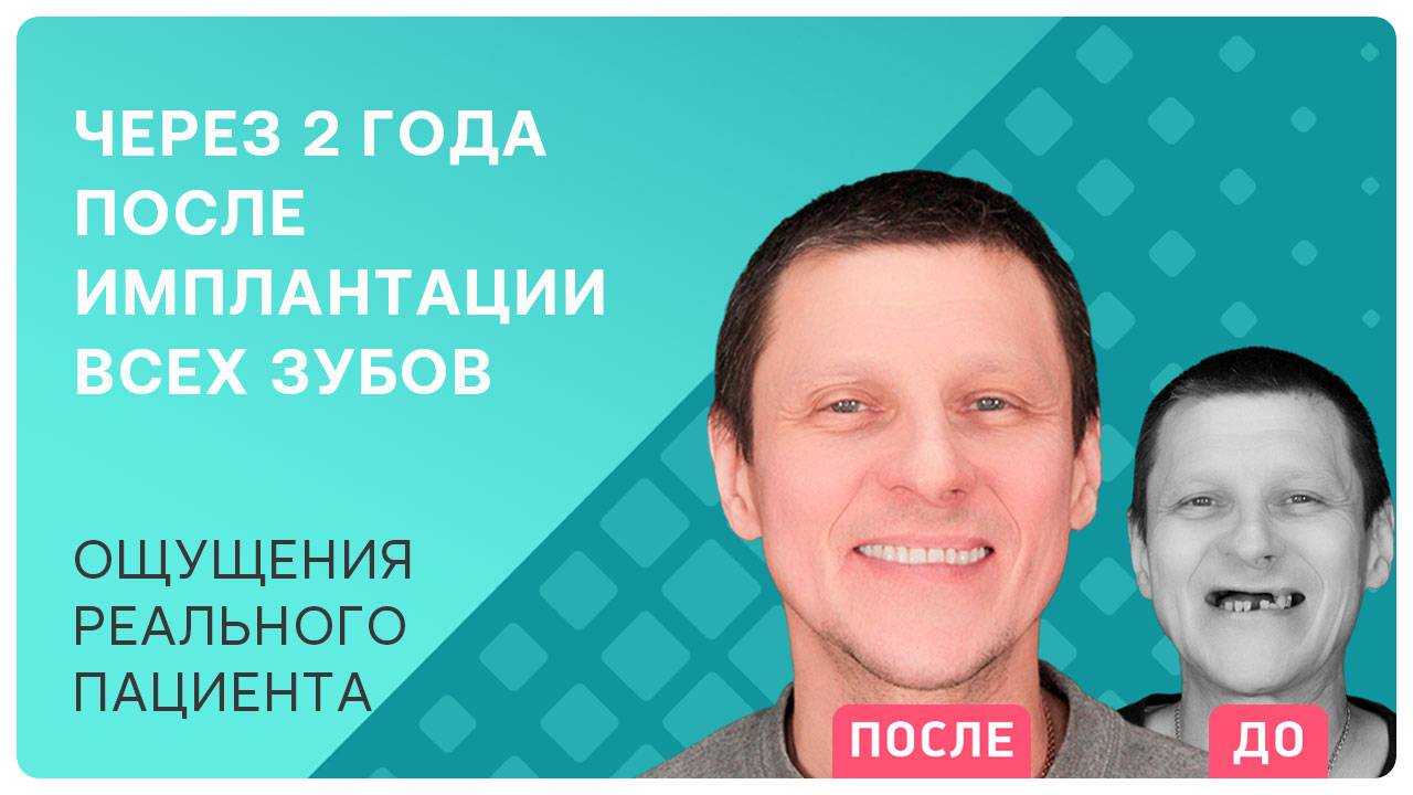 Стоит ли решаться на операцию по имплантации всех зубов? Делюсь опытом через 2 года