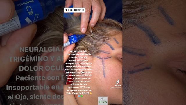 NEURALGIA DEL TRIGÉMINO Y ARNOLD DOLOR OCULAR.