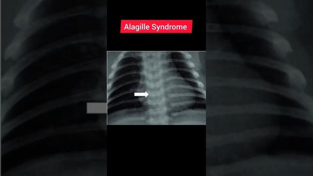 #Alagillesyndrome #disease #pediatrics