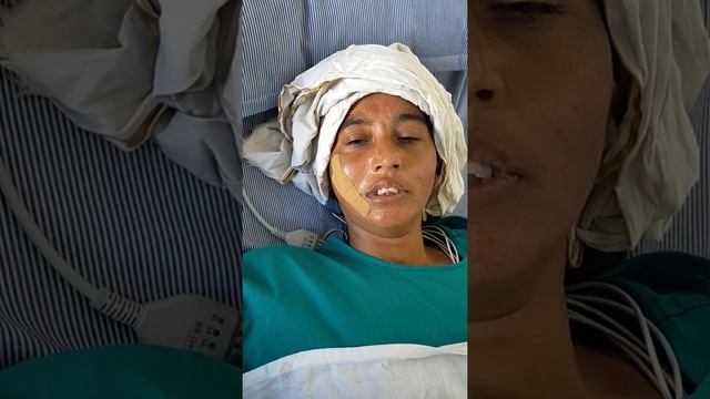 Trigeminal neuralgia, result of radio-frequency ablation by pain physician
