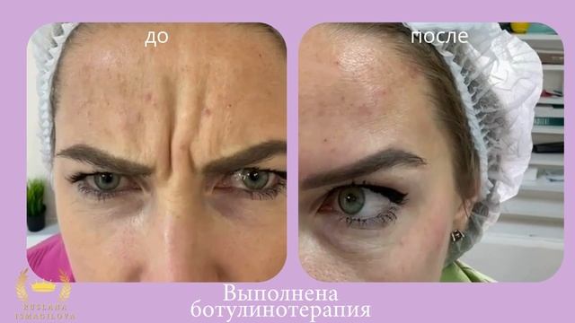 Контурная пластика губ