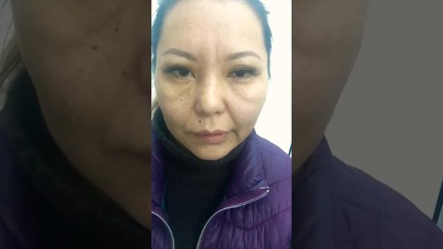 1 год 4 мес после операции Парез лицевого нерва в результате удаления невриномы