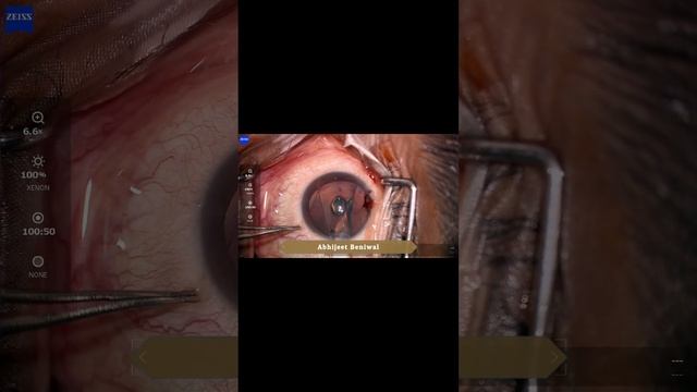ICL #refractivesurgery #nomoreglasses