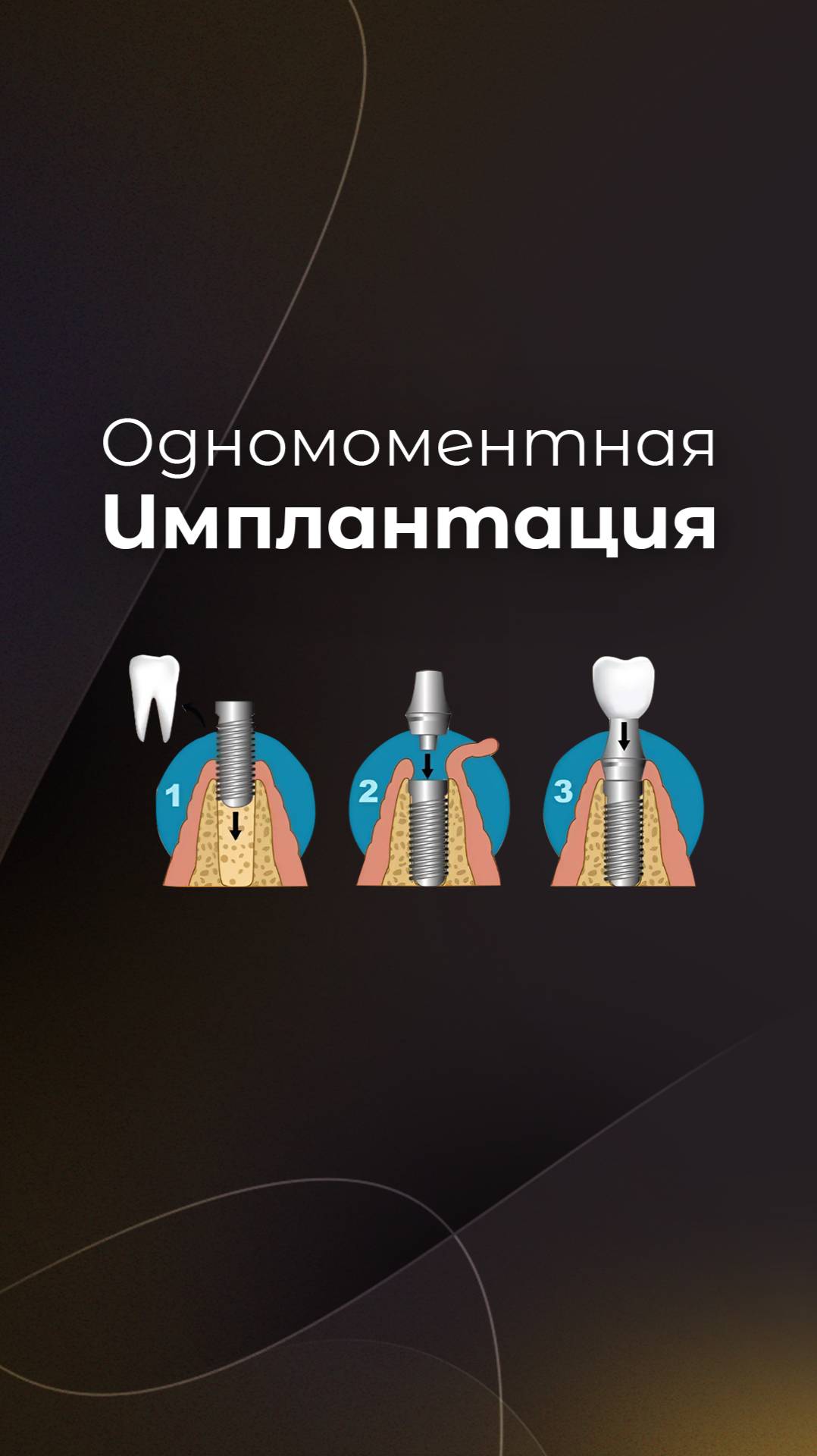 Что такое одномментная имплантация? #AlconDentalClinic #ОдномоментнаяИмплантация