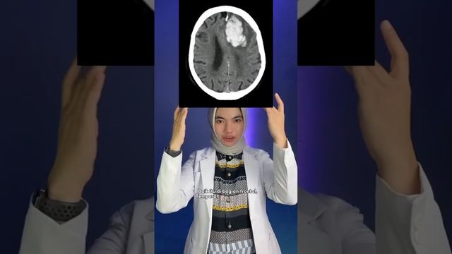3 jenis stroke perdarahan