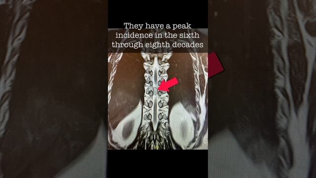 Spinal meningioma