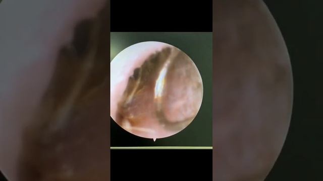Paciente con comenzón y dolor de #oido  por infección por #hongo