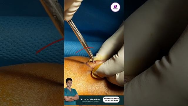 "Step-by-Step Sebaceous Cyst Removal" | "From Bump to Beauty: Sebaceous Cyst Transformation"