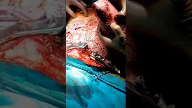 This is how COVID lung looks like 😳