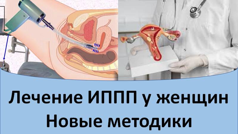 Лечение ИППП у женщин. Новые процедуры