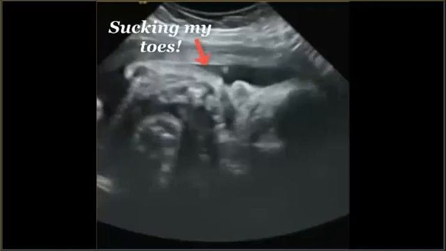 ANTERIOR PLACENTA BABY ULTRASOUND!!. 33.5 Weeks BABY DID GREAT And SHOWED IT'S FACE..