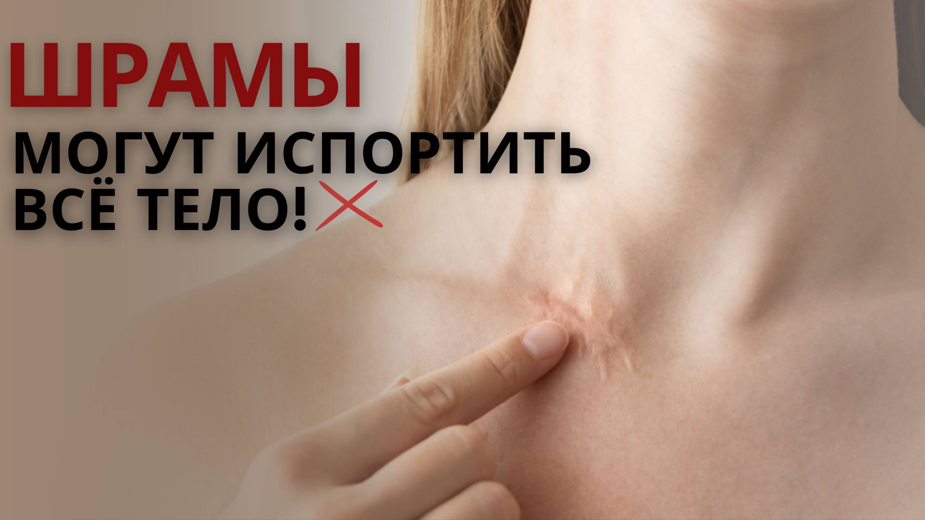Как ШРАМЫ могут испортить тело!