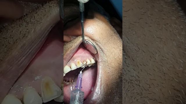 IntraOral Draining Sinus Lavage 😪 #dental #rootcanaltreatment #oralhealth #lavage