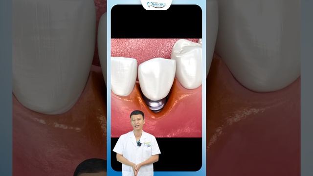 Răng Đào Thải Do Trồng Implant Sai Cách | Nha Khoa Minh Châu