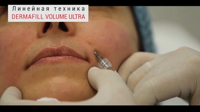 Линейная техника филлером