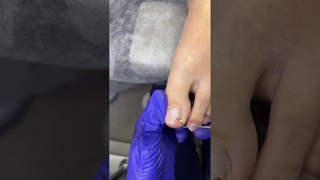 Онихолизис в кабинете nail-мастера