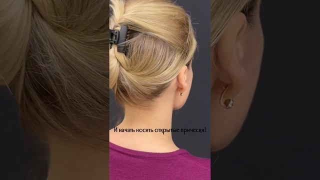 Лопоухость. Отопластика.