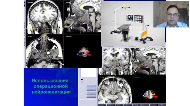 Аденомы гипофиза. Выступление врача-нейрохирурга Лещинского А.В.