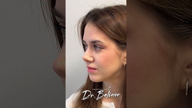 Риносептопластика.