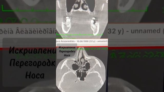 Пластика носа. До и после ринопластики.