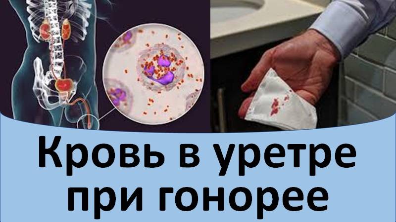 Кровь в уретре при гонорее