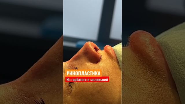 Ринопластика #000546