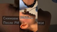 Ринопластика. Интересно? Перейди в профиль. #преображение #омоложение #beforeandafter