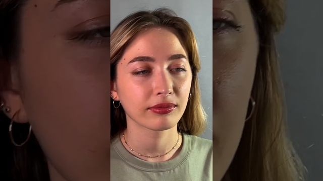 Ринопластика. Еще один результат спустя 1 год.