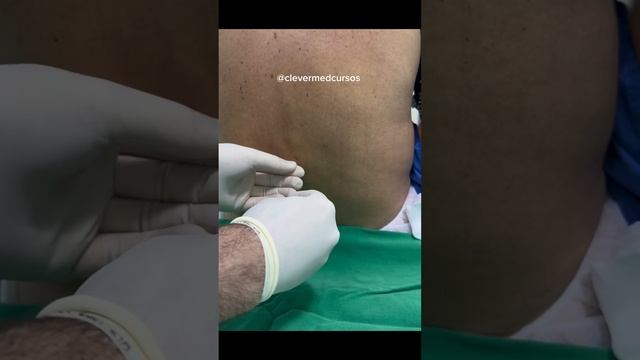 Punção lombar / Raquianestesia / Critical - habilidades médicas / clevermed
