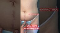 Абдоминопластика, восстановление после родов. #tummytuckrecovery