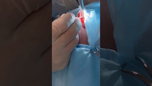 Как проходит операция Септопластика?