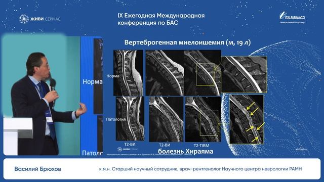 МРТ при болезнях мотонейрона