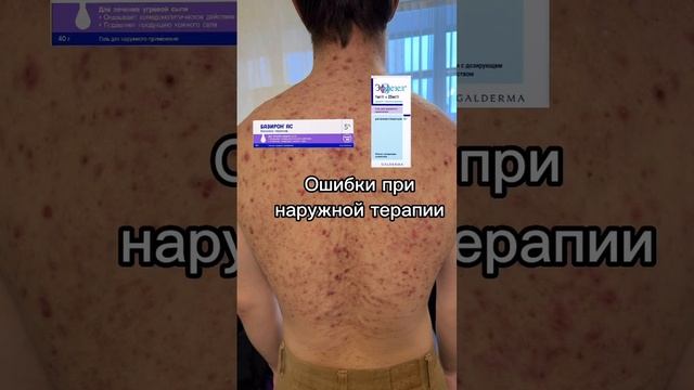 #ошибки #лечим #акне #Подробнее_впосте https://vk.com/wall-43716063_4696.mp4