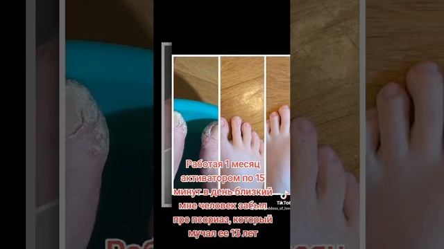 Активатор клеток - псориаз