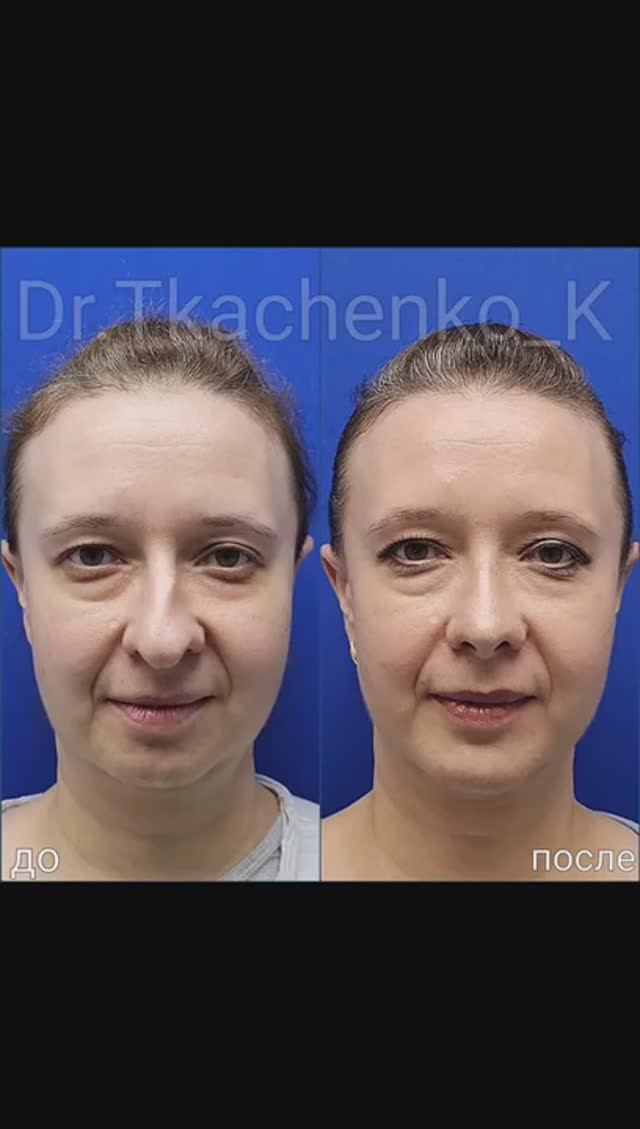 -Увеличение подбородка и ринопластика.
8 месяцев после операции.