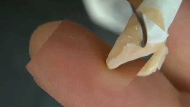 WAX UP CENTRAL INCISOR by Mohamed Alaeddin, Harvard University