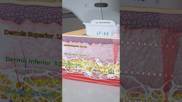 ultraformer 3, подарите себе красоту и молодость,  -10 лет за 1 сеанс