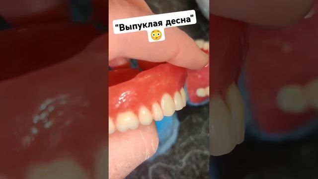 Полный Съёмный Протез. #безнёбасъёмныепротезы #зубныепротезы #съёмныепротезы