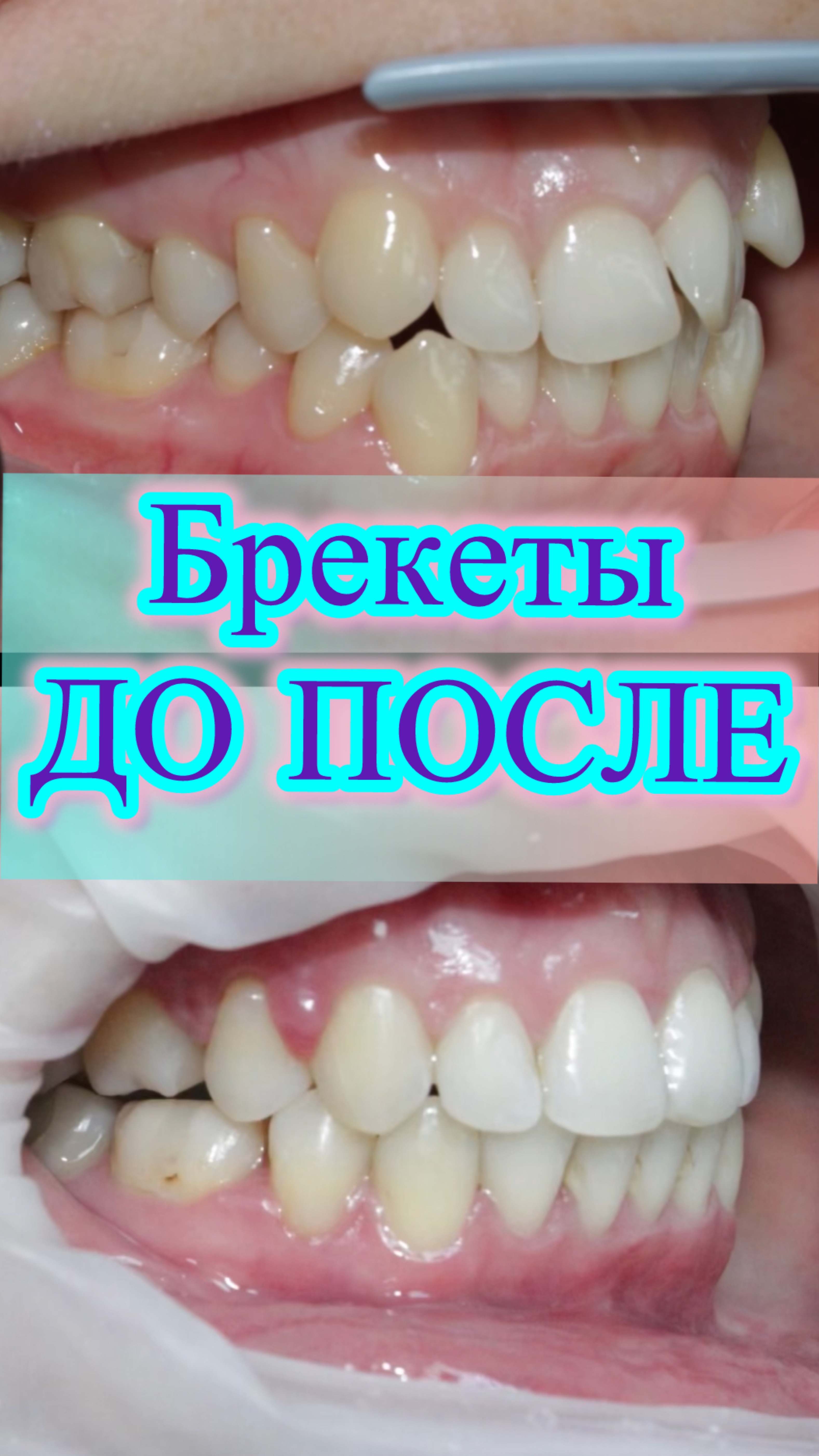 Брекеты ДО ПОСЛЕ. Фото со всех ракурсов.