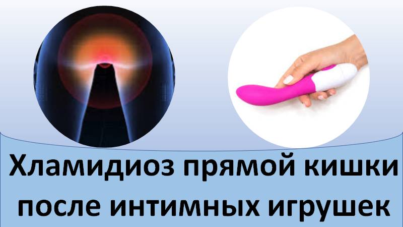 Хламидиоз прямой кишки после интимных игрушек