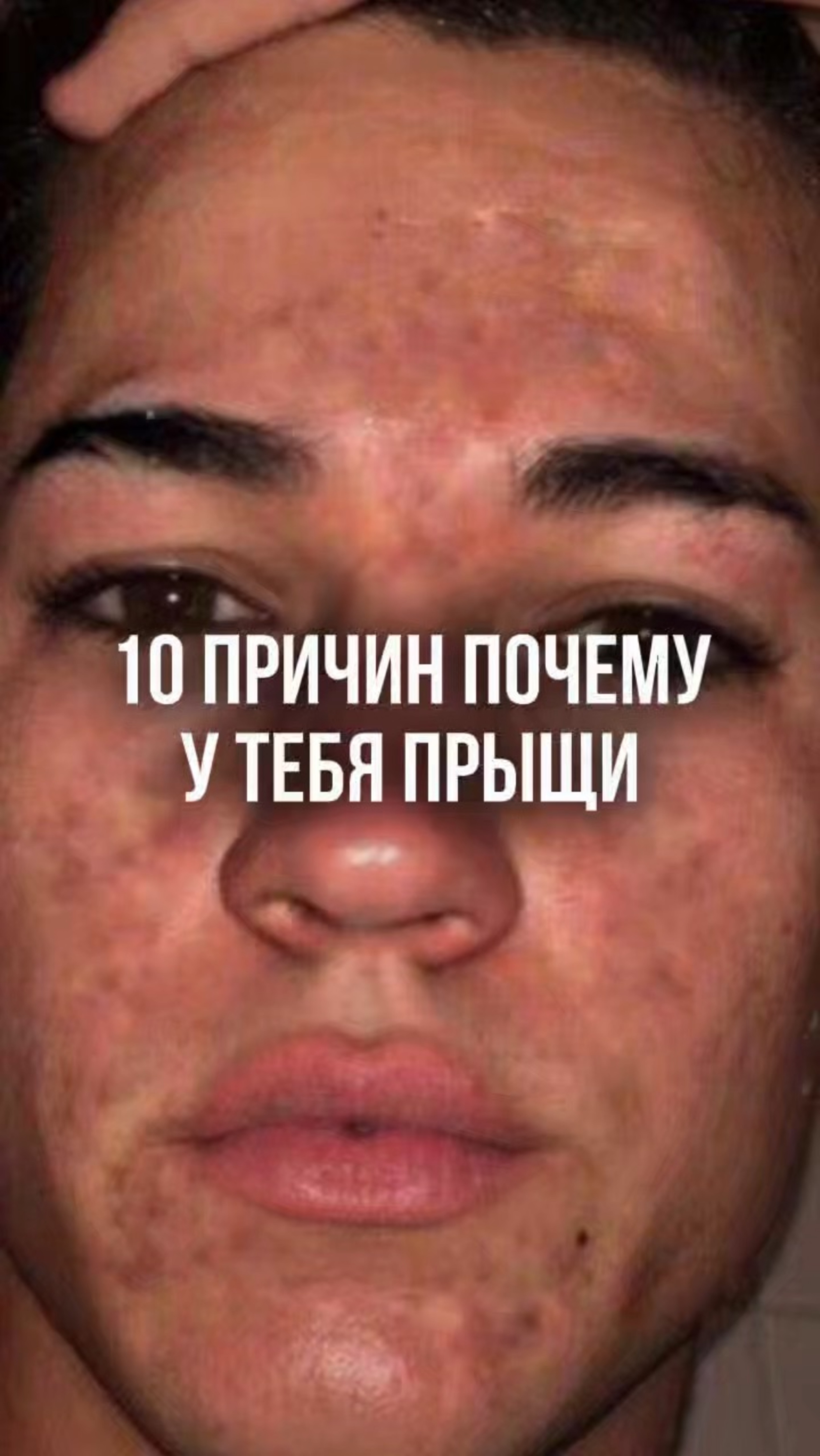 10 ПРИЧИН ПОЧЕМУ У ТЕБЯ ПРЫЩИ.