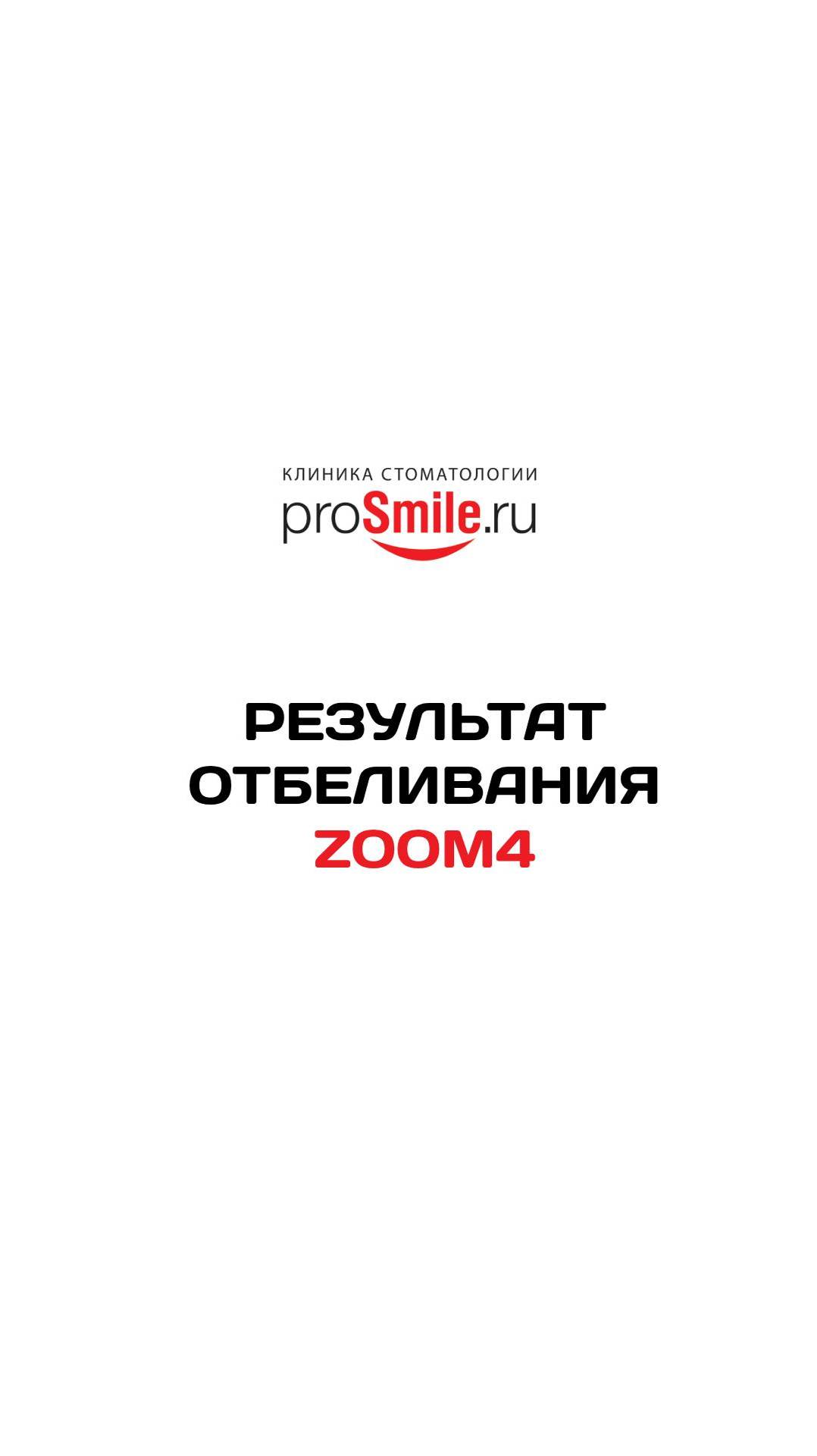 Результат отбеливания ZOOM 4. Работа врача-стоматолога клиники ProSmile.ru, Сафарян Ани Сергеевны.