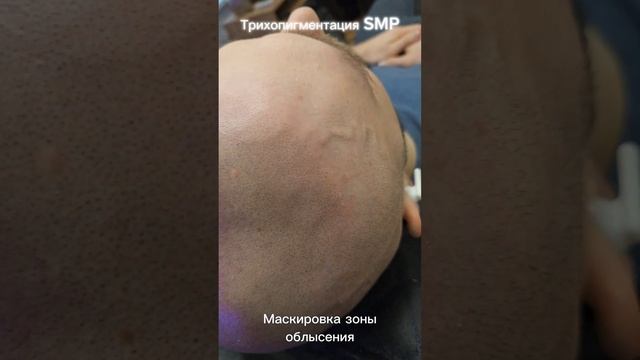 Трихопигментация волос SMP #scalpmicropigmentation #трихопигментация #облысение