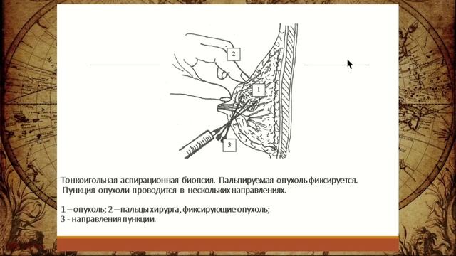 ПРОФЕССОР КИЖАЕВ  Е.В. ФИБРОЗНО-КИСТОЗНАЯ МАСТОПАТИЯ 2