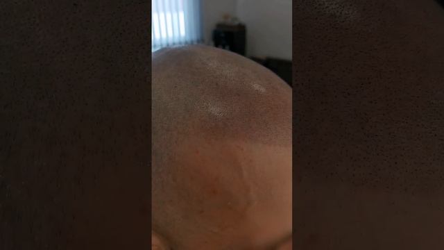 Трихопигментация, Scalpmiropigmentation Краснодар