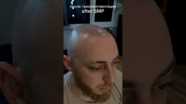 трихопигментация со светло-русыми волосами #scalpmicropigmentation #трихопигментация #краснодар