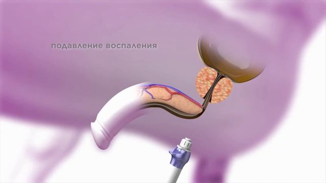 Лечение простатита методом УВТ