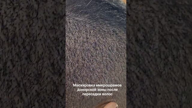 Маскировка микрошрамов донорской зоны после пересадки волос #пересадкаволос #трихопигментация