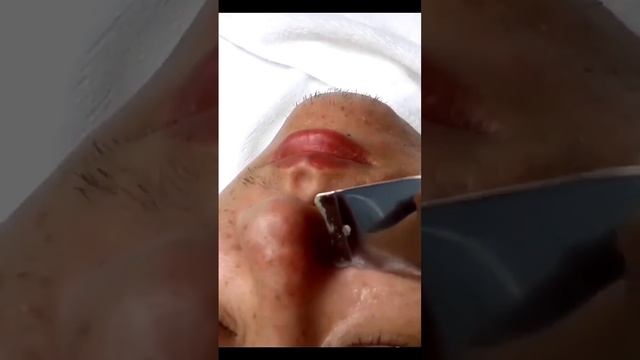 Ультразвуковой пилинг для удаления черных точек Скраб.