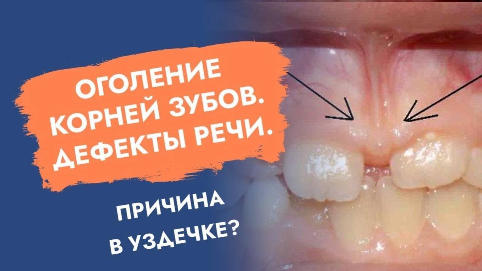 Оголение корней передних зубов. Причины и своевременное лечение!